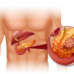 Pancreas Specialist in Hyderabad